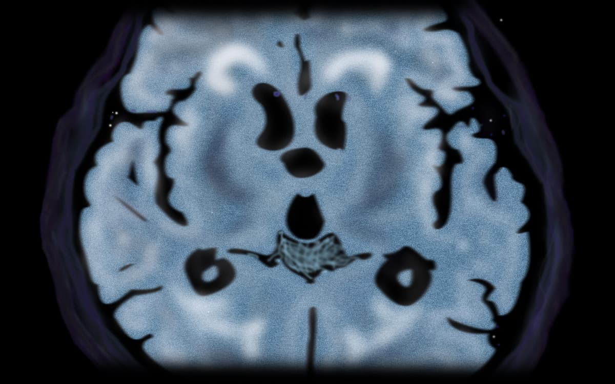MRI Brain